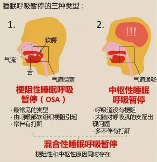 成人一分钟呼吸6次正常吗睡眠呼吸暂停一小时30次一个月婴儿连续呼吸短暂几秒停止是什么原因呢 汽车1